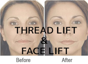cosmetic surgery in Udaipur - thread lift & face lift