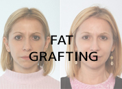cosmetic surgery in Udaipur - fat grafting