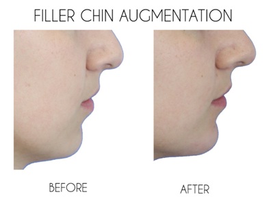 Chin Augmentation surgery in udaipur