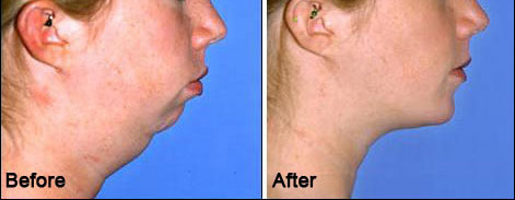 Chin Surgery in Udaipur