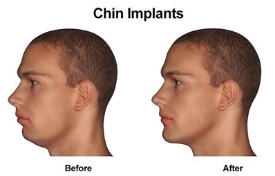 Chin Augmentation surgery in udaipur