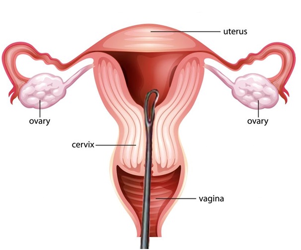 Dilation and Curettage of Uterus in Udaipur