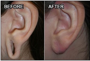 ear lobe correction surgery in Udaipur