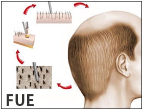 fue & fut hair transplant differences - best hair transplant in udaipur