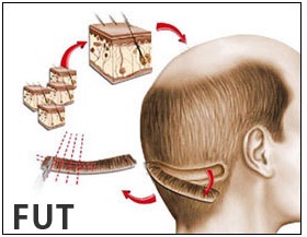 fue & fut hair transplant differences - best trichologist in udaipur