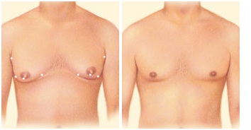 Male Breast Reduction Surgery in Udaipur - liposuction technique