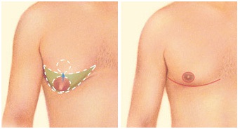 Male Breast Reduction Surgery in Udaipur - Combination of liposuction & excision techniques