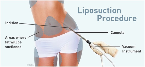 Liposuction & Body Sculpting Cosmetic Surgery in Udaipur