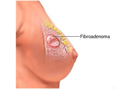 Breast Swelling Treatment in Udaipur