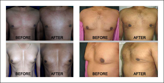 Male Breast Reduction Surgery in Udaipur