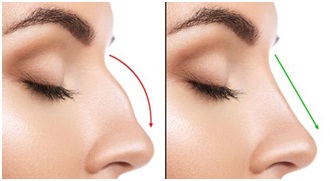 Nose Surgery in Udaipur