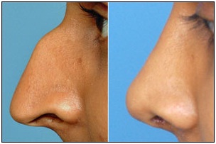 Best Doctors For Nose Surgery in Udaipur