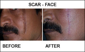 Scar Revision Surgery in Udaipur