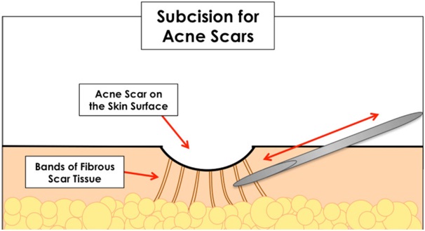 Subscision Treatment for acne scars