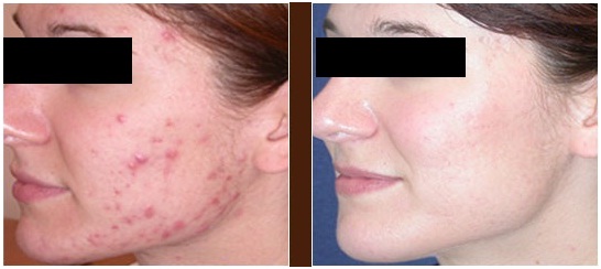 chemical peels for acne scar treatments
