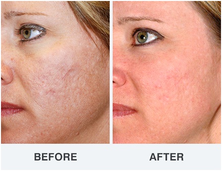 surgical treatment of acne scars