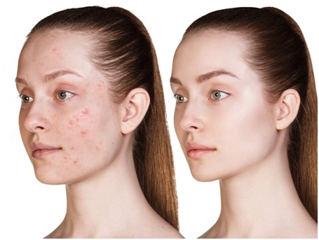 laser treatment for acne scars in Udaipur