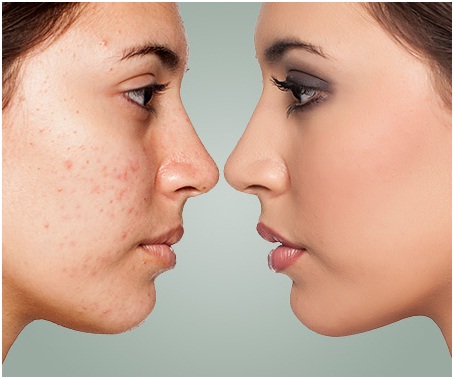 microneedling for pimple scar removal treatment in Udaipur
