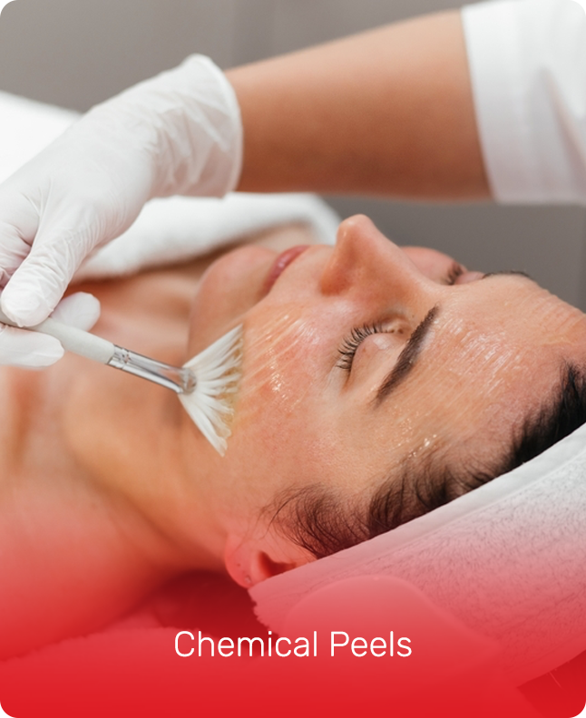 CHEMICAL PEELS