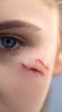 FACIAL-INJURIES-AND-FRACTURESpng