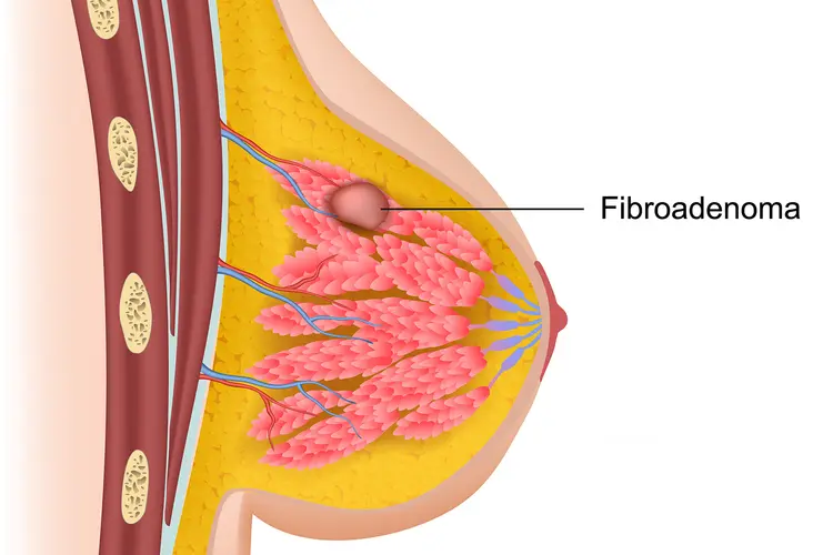Fibroadenoma