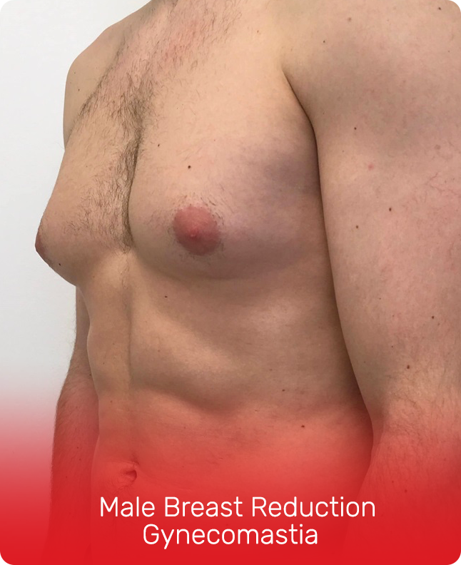 MALE BREAST REDUCTION GYNECOMASTIA