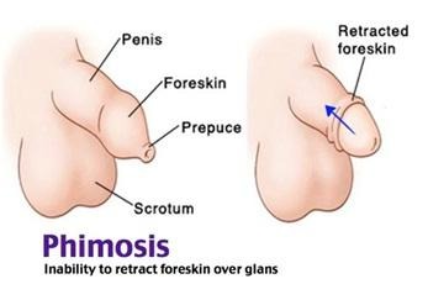 PHIMOSIS-TREATMENT