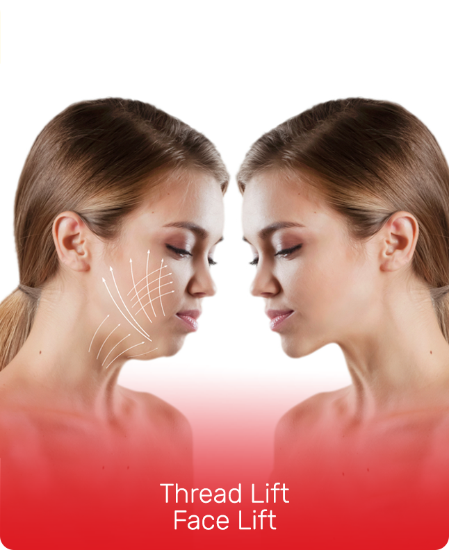 THREAD LIFT FACE LIFT