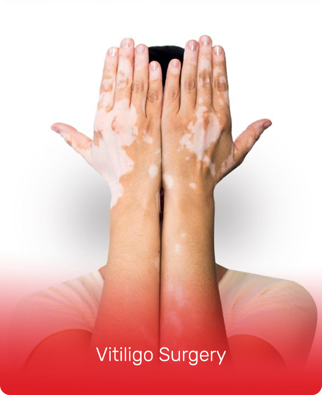 VITILIGO SURGERY