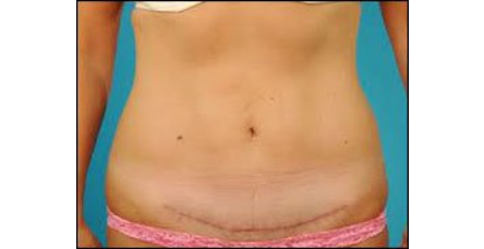 after-abdominoplasty (1)