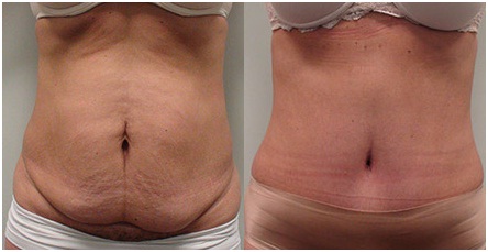 after-abdominoplasty