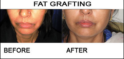 fat-grafting-1
