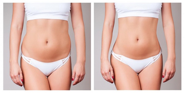 liposuction-procedure-2