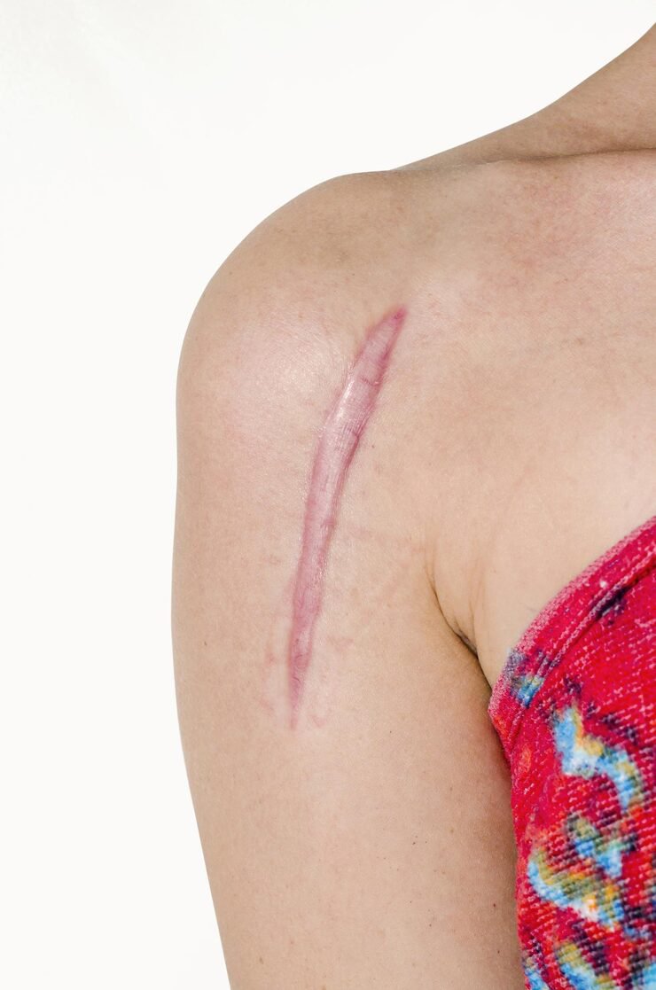 midsection-woman-with-wound-shoulder-against-white