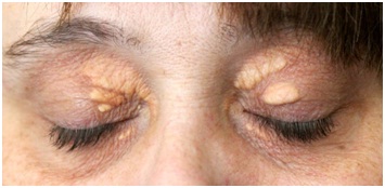 xanthelasma-1