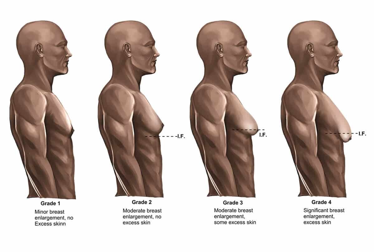 Grades of Gynecomastia