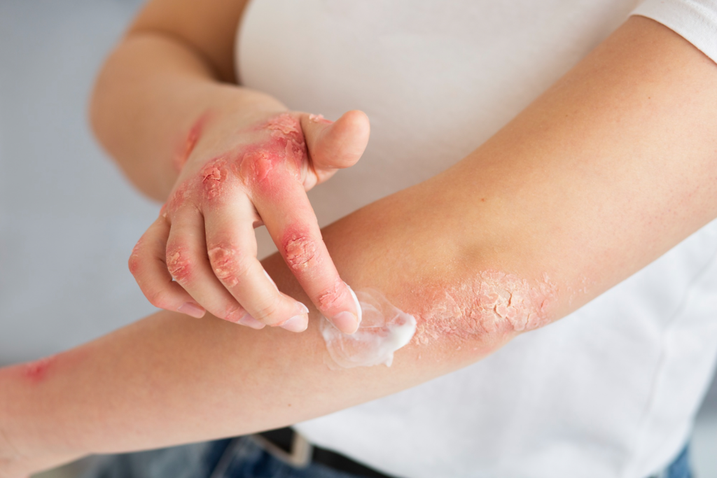 Managing Burns & Post-Burn Deformities: Recovery and Rehabilitation